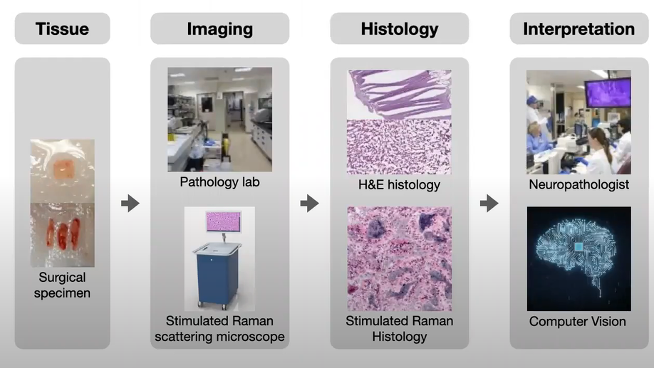 Machine Learning for Intraoperative Diagnosis of Brain Tumors Imaged using Stimulated Raman Histology